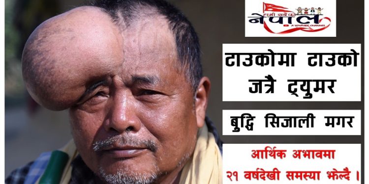 टाउकोमा २१ वर्षदेखि टाउको जत्रै ट्युमर (भिडियो सहित हेर्नुस)
